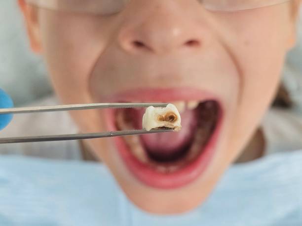 Best Emergency Dentist for Lost Fillings or Crowns in Janesville, IA